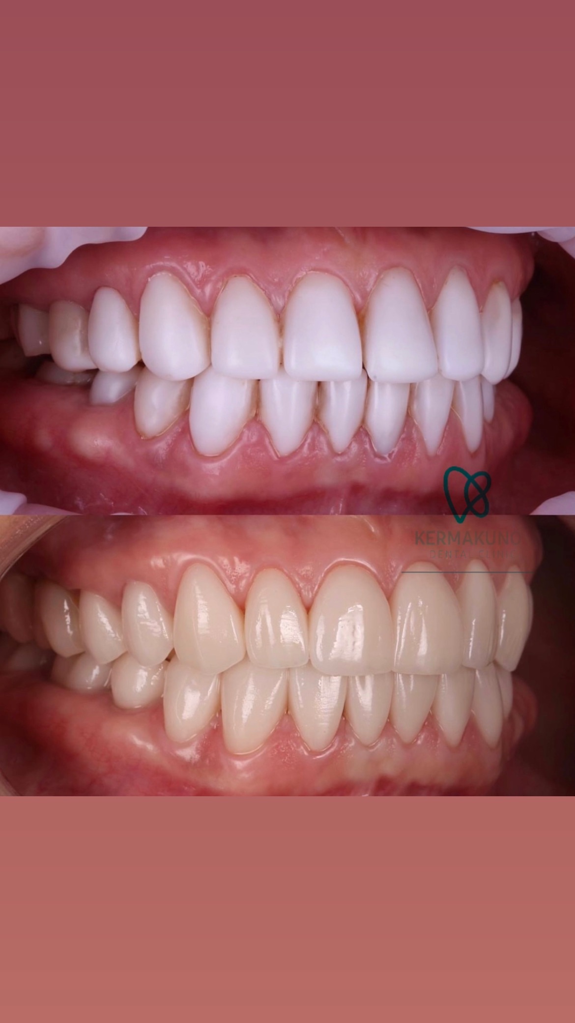 До/После лечения