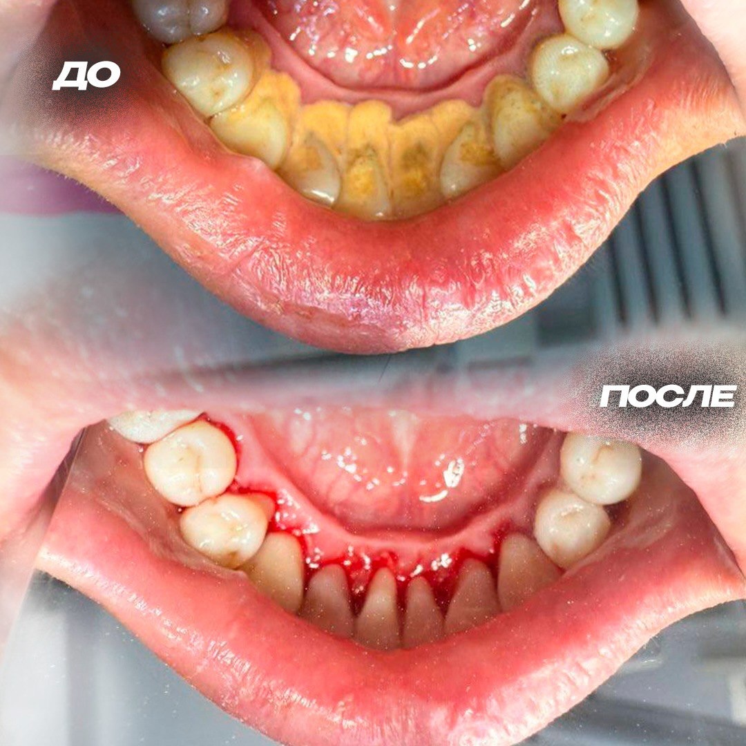 Профессиональная чистка