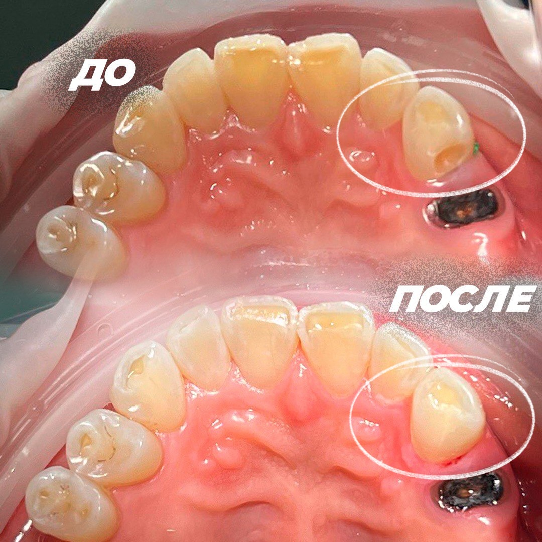 До и после лечения
