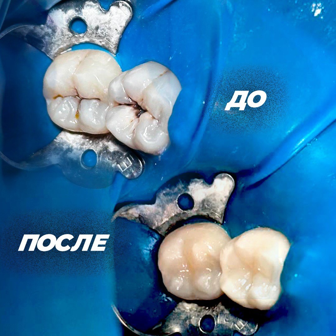 Лечение каналов